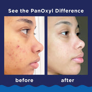 PanOxyl Acne Foaming Wash, For Face & Body, Maximum Strength - 156g